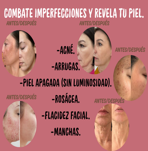BEAUTY&EMS™ DISPOSITIVO MESOTERAPIA +ENVÍO GRATIS